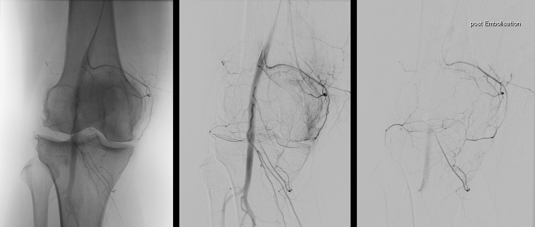 TAPE am rechten Kniegelenk – Angiographie vor und nach Embolisation